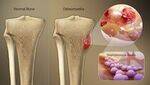 Osteomyelitis, Septic Arthritis