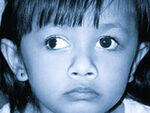 Squint, Strabismus - 1