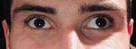 Squint, Strabismus - 2