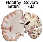 CNS - Alzheimers, CNS tumors