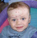 Chicken Pox, Measles, Rubella, mPOX, Diphtheria