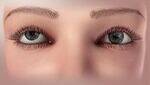 Squint, Strabismus