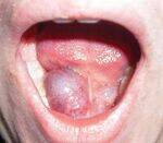 Salivary gland - Ranula, Parotid abscess, Sialolithiasis, Parotid and Submandibular Tx