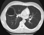 CVS Radiology - Congenital conditions, MS, CHF, AD, PE