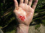 Injury, Abrasion, Contusion, Wounds