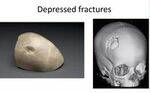 Head Injury, ICH, Vehicular Injuries