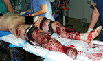 Thermal, Burns, Electrical Injury, Torture Methods, Blast Injuries