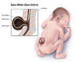Neural Tube Defects and CNS