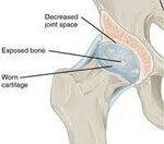Joint disorders - OA, RA, Ankylosing spondylitis, Gout, Pseudogout