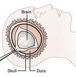 Neurosurgery