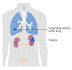 Renal System and Neuroendocrine tumors