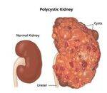 PCKD, Horseshoe kidney, Hydronephrosis, Renal and Bladder Stones