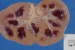 Renal Injury, Infections, Tumors