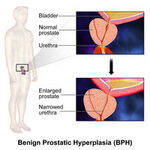 Prostate - Basics, BPH, Cancer