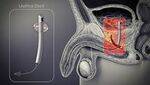 Foleys, Bladder Trauma and Carcinoma, Urethra Anomalies, Penis