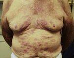 Anti Tubercular and Leprosy Drugs