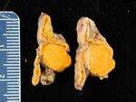 Adrenal conditions - Adenoma, Pheochromocytoma, Neuroblastoma, Carcinoids
