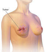 Breast Pathology, Bone and Soft tissue Tumor