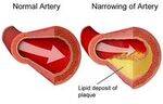 Arterial Disorders - Occlusion, TAO, Atherosclerosis, Gangrene