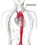 Arterial Disorders - Aneurysm, Dissection, Raynauds, AV fistula