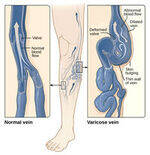 Venous Disorders - DVT, Varicose veins, Venous ulcer