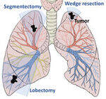 Lung Cancer and Mediastinal Tumors
