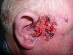 Skin - Ulcers, BCC, Malignant melanoma, Soft Tissue Sarcomas