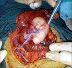 Bleeding, Abortion, APLA, Cervical Incompetence