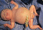 MTP and Rh-Negative Pregnancy