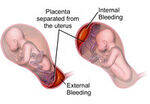Antepartum hemorrhage - Placenta Previa, Abruptio Placenta