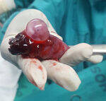 Molar and Ectopic Pregnancy