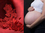 Anemia in Pregnancy