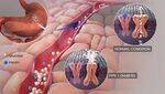 Gestational Diabetes Mellitus
