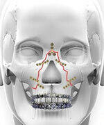 Septum, Nasal and Facial fracture