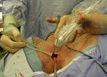 Drains, Sutures, Needles, Knots, Post op fever, Wound, Hand Hygiene