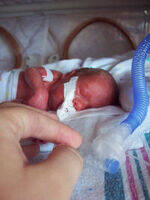 Preterm Labour, Lie, Presentation