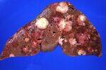 Hepatitis - Acute and Chronic, AIH, PBC, PSC, Metabolic and Decompensated liver disease