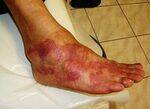 Inflammation - Steps, Leucocyte function defects, Mediators, Granuloma, Healing