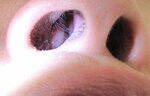 Polyps, Benign and Malignant Conditions of Nose