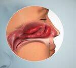 Atrophic Rhinitis, Granulomatous conditions of Nose