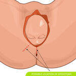 PPH, Retained Placenta, Uterine Inversion, Amnitotic Fluid Embolism, Perineal Tear and Episiotomy