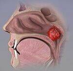 Nasopharynx - Adenoid, Ca, Angiofibroma