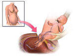 C-section, VBAC, TOLAC, Instrumental Delivery