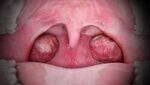 Oropharynx - Tonsillitis, Tonsillectomy