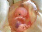Preconceptional advice, ANC, Amniotic Fluid