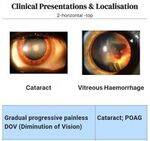 Ophthalmology Flashcards 3 - Lens, Retina