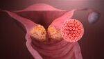 Cancer Cervix