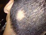 Alopecia, Glands, Acne, Bullous disorders - Pemphigus, BP, DH