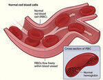 Hematopoiesis, Anemia Basics, Hypoproliferative Anemias - IDA, AOCD, Sideroblastic, Thalassemia, B12, Folate deficiency,