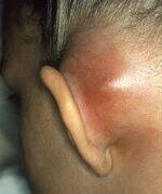 Cholesteastoma, Acute mastoiditis, Audiology Tests